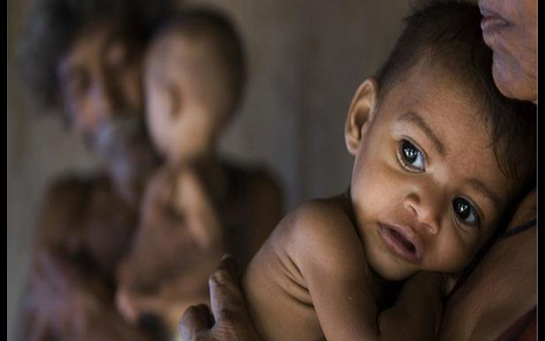 child-malnutrition
